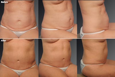 Tummy Tuck Before & After Gallery - Patient 257135 - Image 1