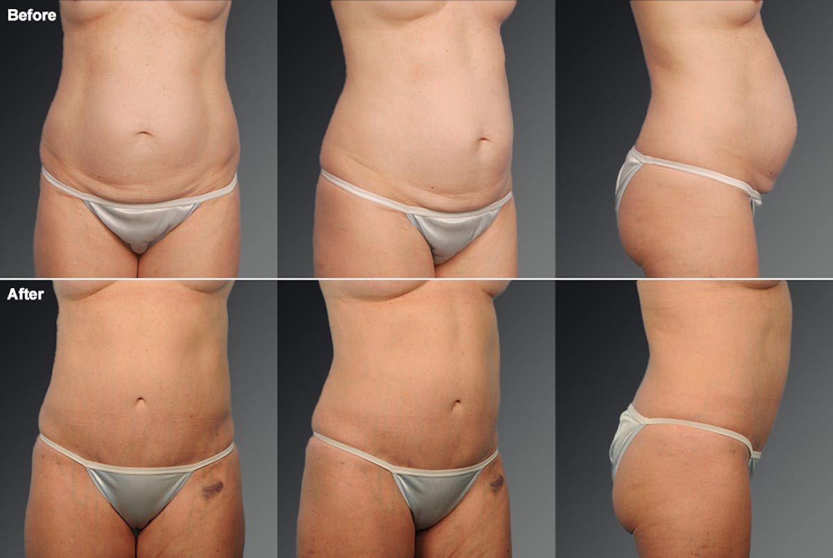 Tummy Tuck Before & After Gallery - Patient 118657 - Image 1