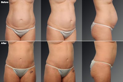 Tummy Tuck Before & After Gallery - Patient 118657 - Image 1