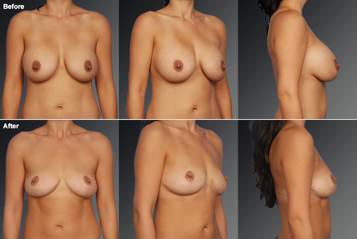 Explantation Before & After Gallery - Patient 899835 - Image 1