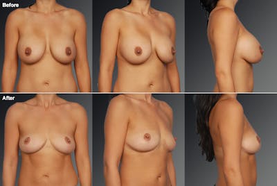 Explantation Before & After Gallery - Patient 899835 - Image 1