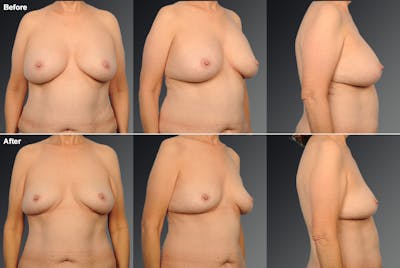 Explantation Before & After Gallery - Patient 271304 - Image 1