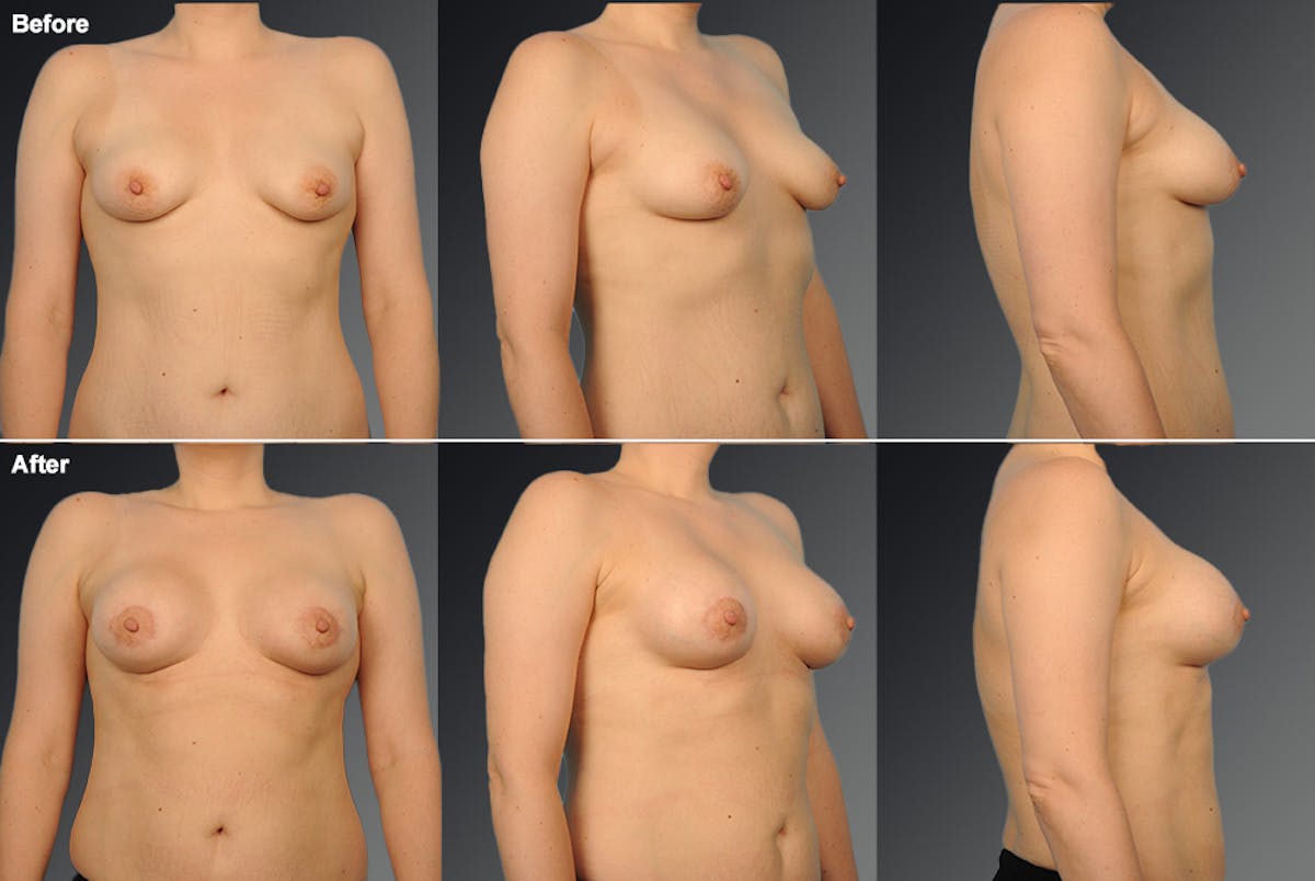 Breast Donut Lift Before & After Gallery - Patient 283608 - Image 1