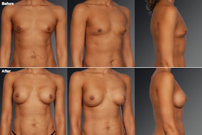 African American Breast Augmentation  Before & After Gallery - Patient 115157 - Image 1