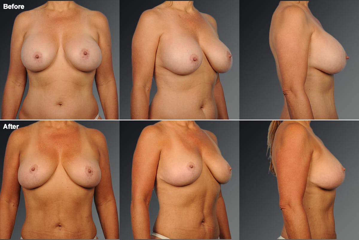 Explantation Before & After Gallery - Patient 385120 - Image 1
