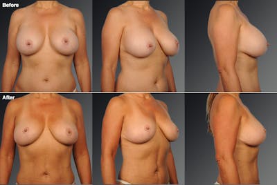 Explantation Before & After Gallery - Patient 385120 - Image 1