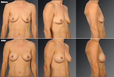Breast Augmentation Before & After Gallery - Patient 424821 - Image 1