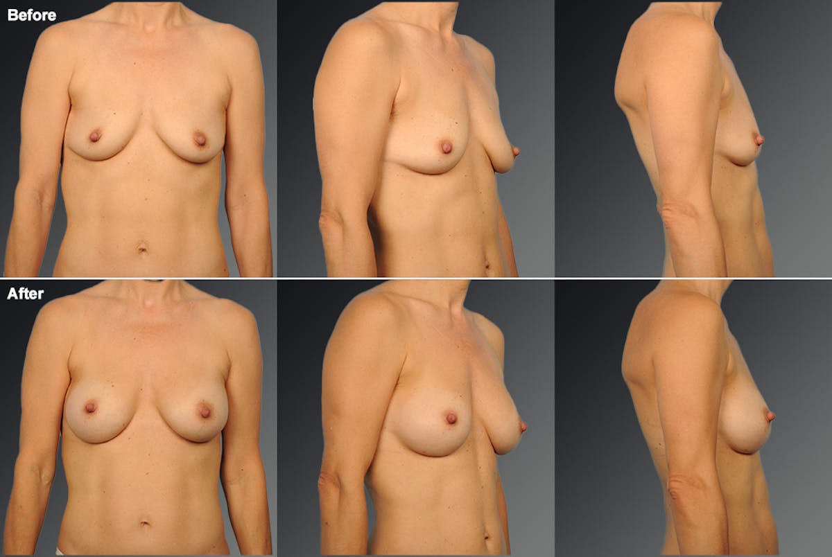 Breast Augmentation Before & After Gallery - Patient 424821 - Image 1