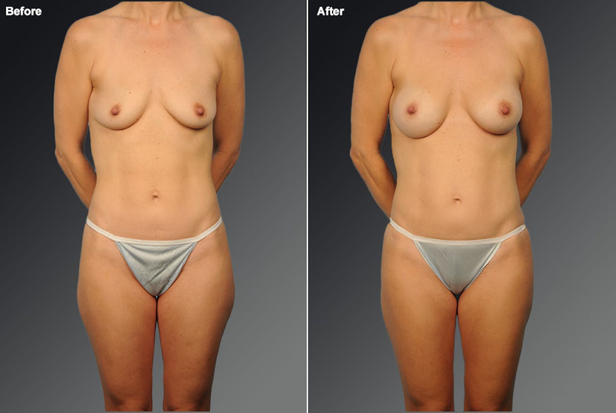 Mommy Makeover Before & After Gallery - Patient 873633 - Image 1