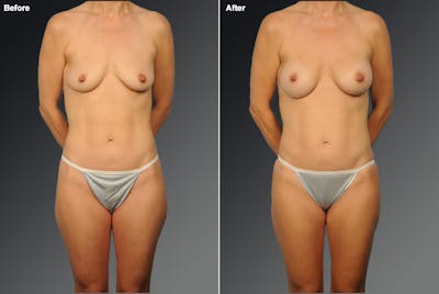 Mommy Makeover Before & After Gallery - Patient 873633 - Image 1