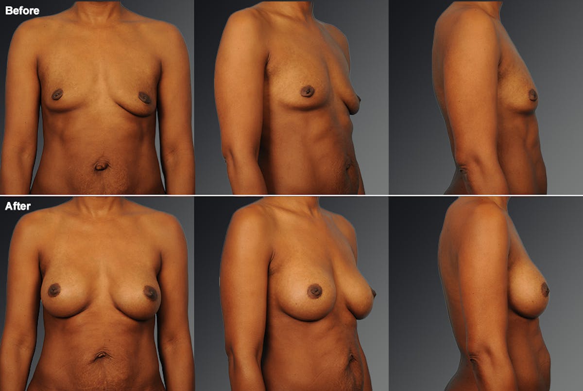 African American Breast Augmentation  Before & After Gallery - Patient 258851 - Image 1