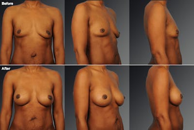 African American Breast Augmentation  Before & After Gallery - Patient 258851 - Image 1