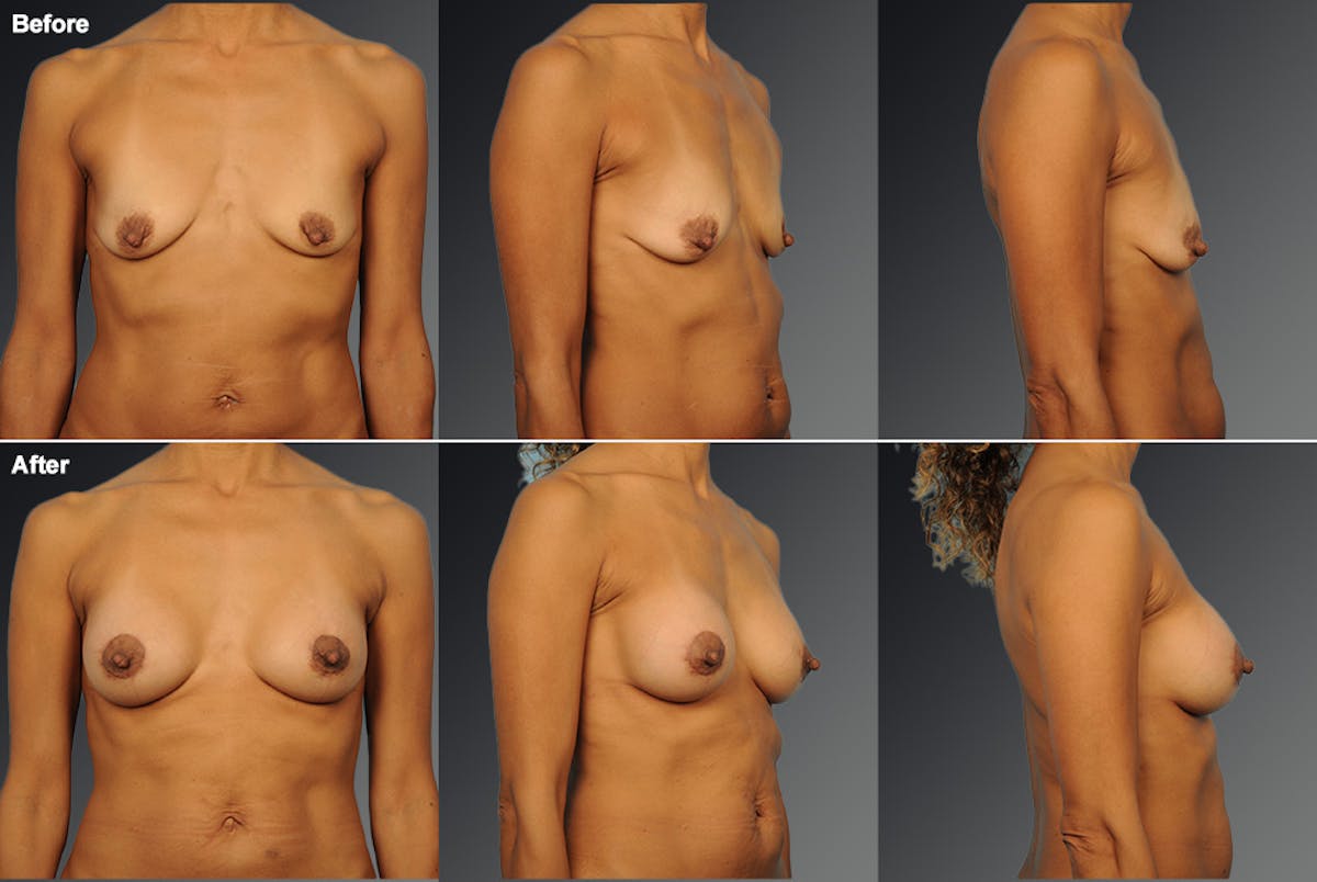 Breast Donut Lift Before & After Gallery - Patient 263087 - Image 1