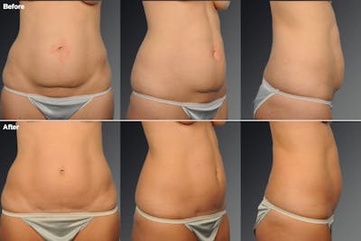 Mini Tummy Tuck Before & After Gallery - Patient 350995 - Image 1