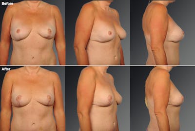 Explantation Before & After Gallery - Patient 334884 - Image 1