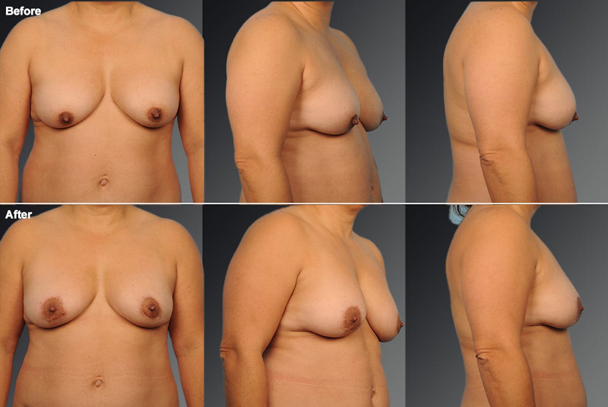 Breast Donut Lift Before & After Gallery - Patient 165588 - Image 1