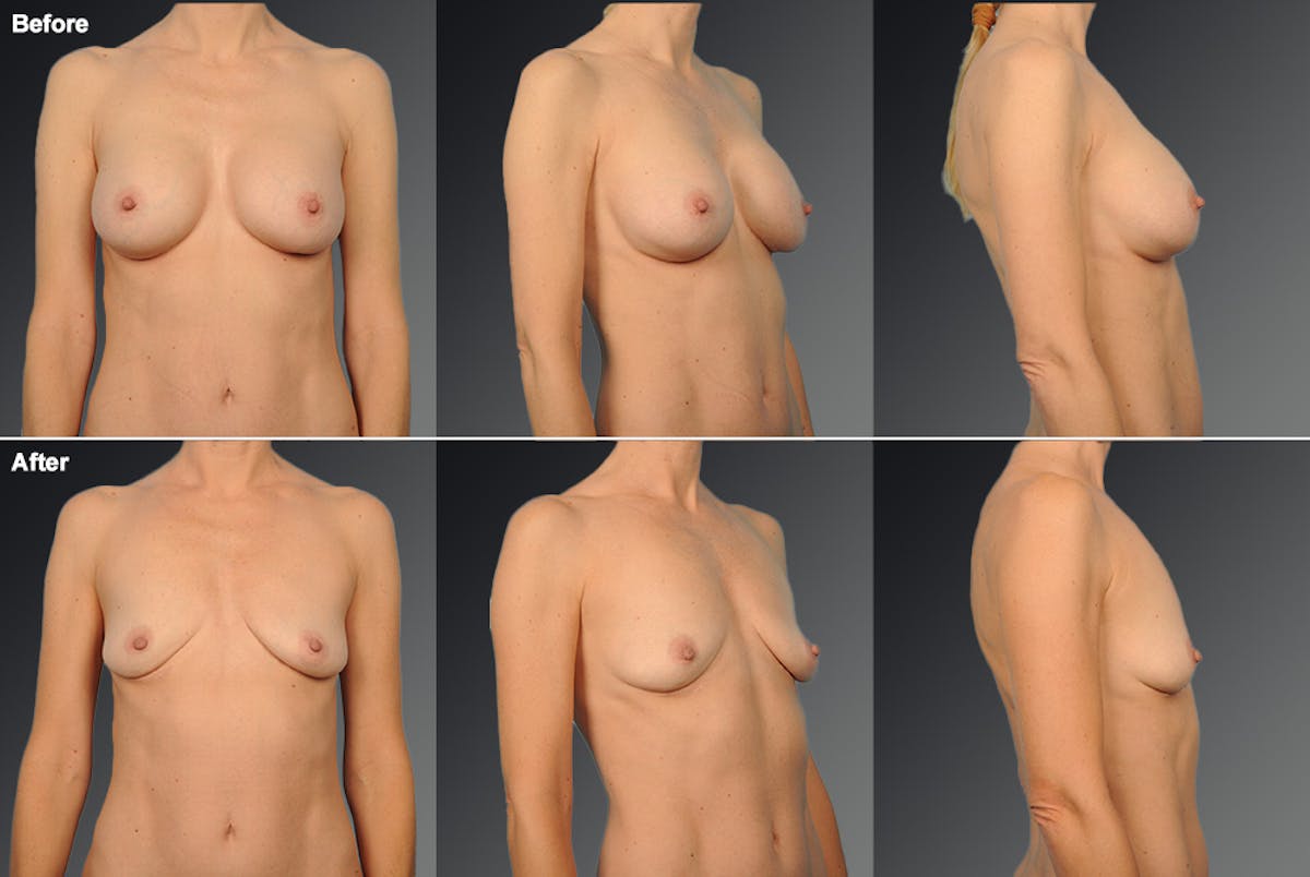 Explantation Before & After Gallery - Patient 255002 - Image 1