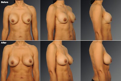 Capsular Contracture Before & After Gallery - Patient 116896 - Image 1
