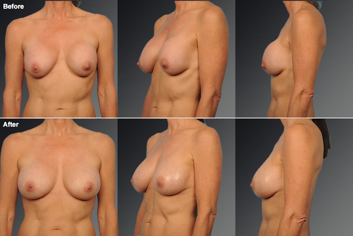 Capsular Contracture Before & After Gallery - Patient 352764 - Image 1