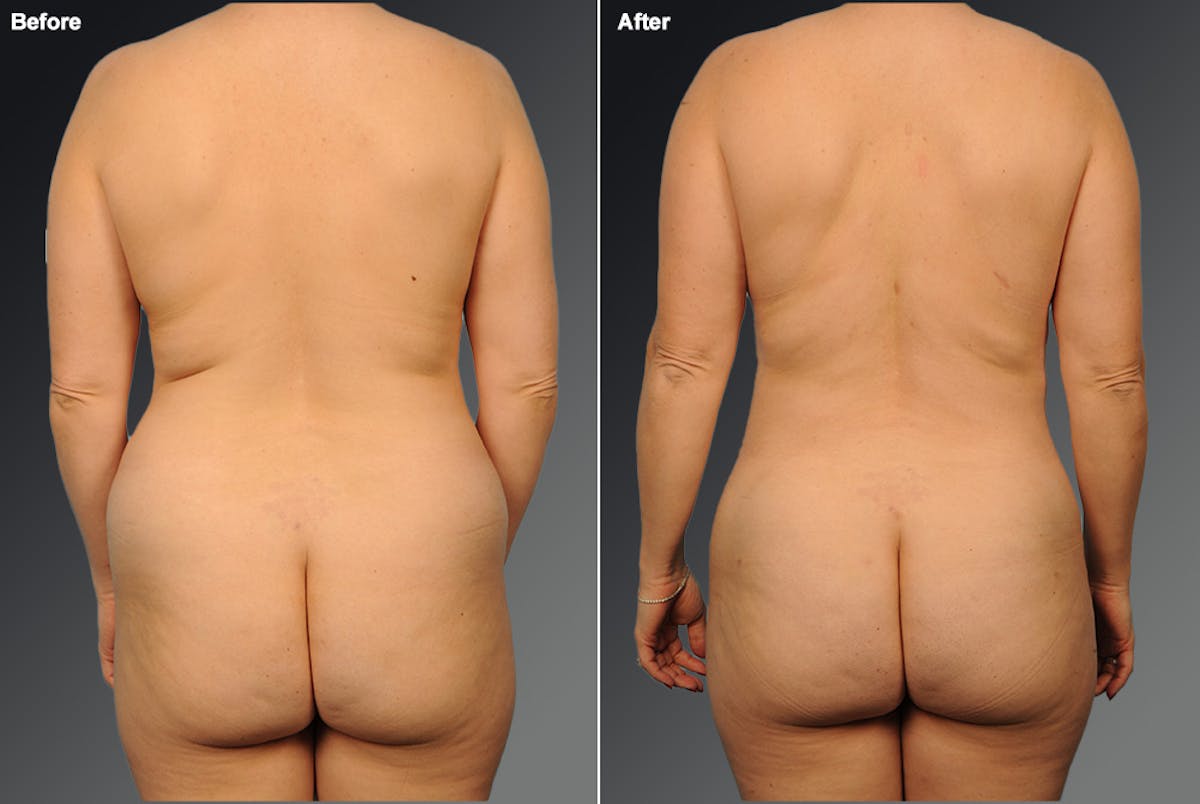 Liposuction Before & After Gallery - Patient 419901 - Image 1