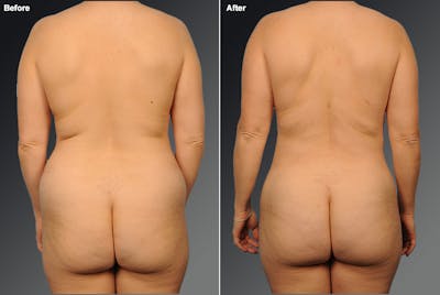 Liposuction Before & After Gallery - Patient 419901 - Image 1