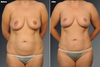 Mommy Makeover Before & After Gallery - Patient 375540 - Image 1