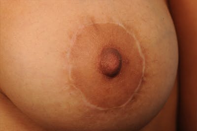 Breast Donut Lift Before & After Gallery - Patient 368753 - Image 1