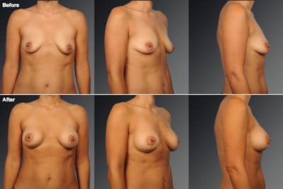 Breast Donut Lift Before & After Gallery - Patient 300341 - Image 1