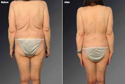 Liposuction Before & After Gallery - Patient 357179 - Image 1