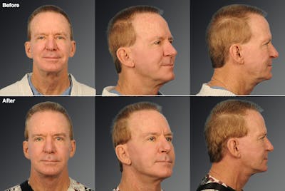 Face and Neck Lift Before & After Gallery - Patient 920400 - Image 1