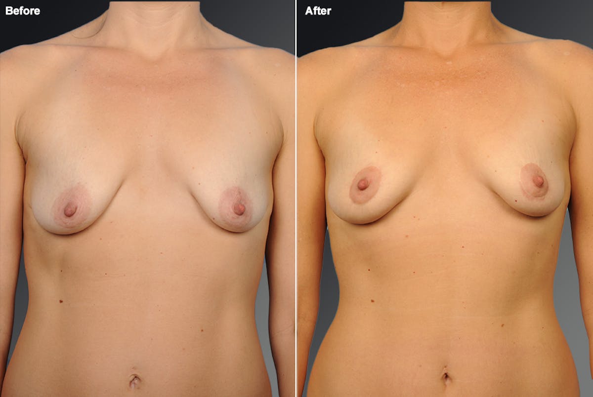 Breast Donut Lift Before & After Gallery - Patient 136371 - Image 1