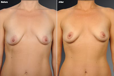 Breast Donut Lift Before & After Gallery - Patient 136371 - Image 1