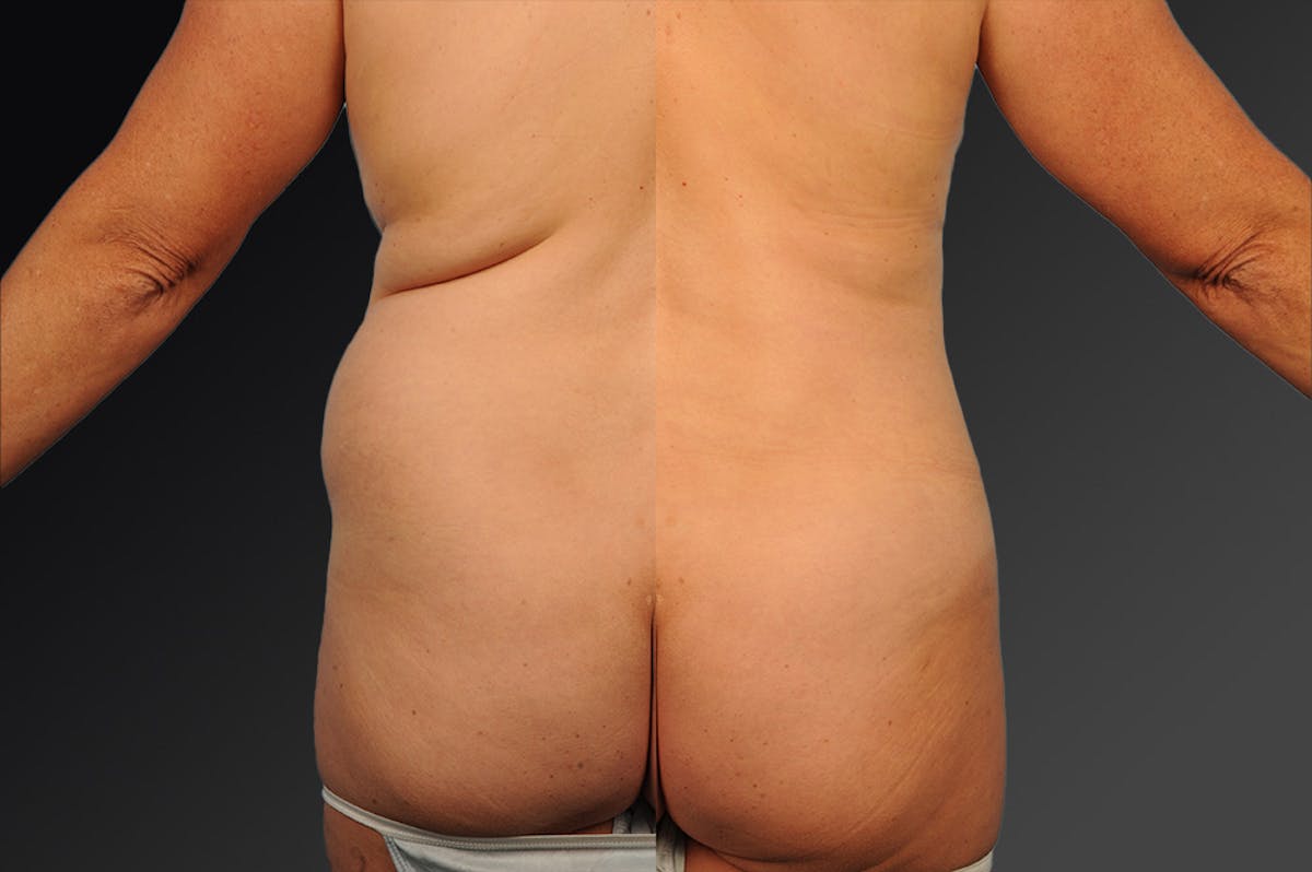 Liposuction Before & After Gallery - Patient 194444 - Image 1