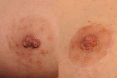 Nipple Reduction Before & After Gallery - Patient 120160 - Image 1