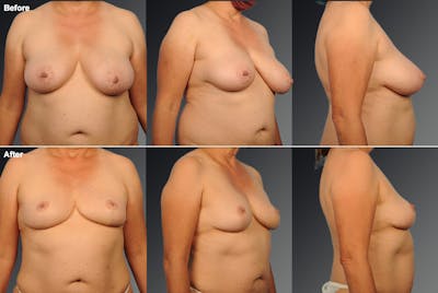 Liposuction Before & After Gallery - Patient 158252 - Image 1