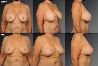 Explantation Before & After Gallery - Patient 182314 - Image 1