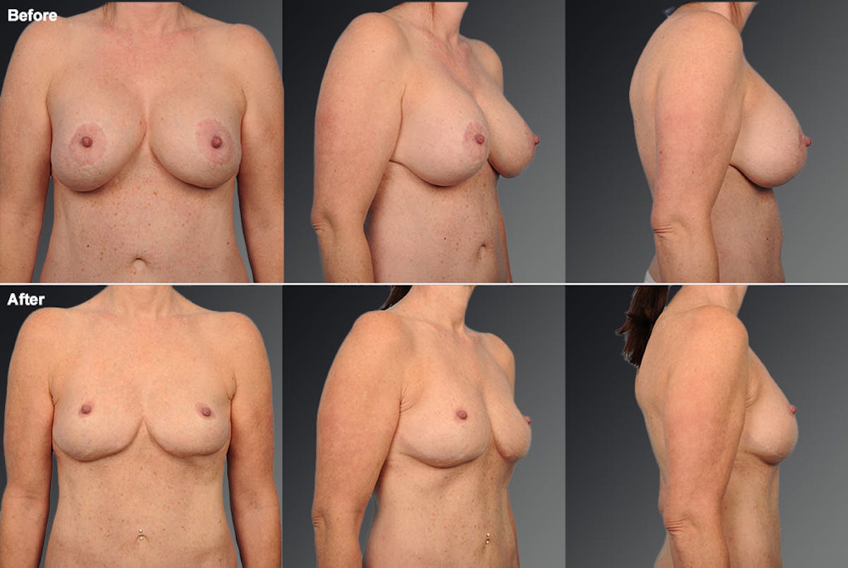 Breast Implant Revision Before & After Gallery - Patient 889821 - Image 1