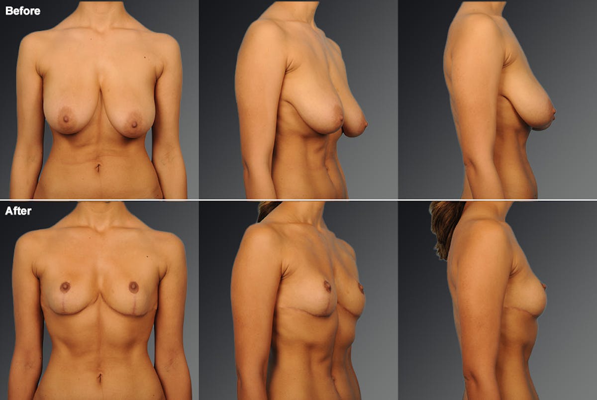 Standard Before & After Gallery - Patient 366538 - Image 1