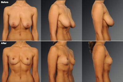 Standard Before & After Gallery - Patient 366538 - Image 1