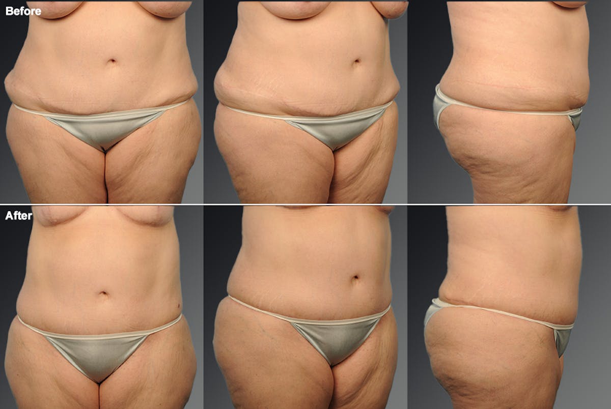 Tummy Tuck Before & After Gallery - Patient 257573 - Image 1