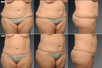 Tummy Tuck Before & After Gallery - Patient 257573 - Image 1