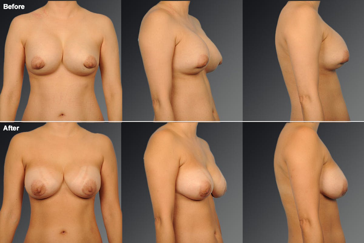 Breast Implant Revision Before & After Gallery - Patient 276773 - Image 1