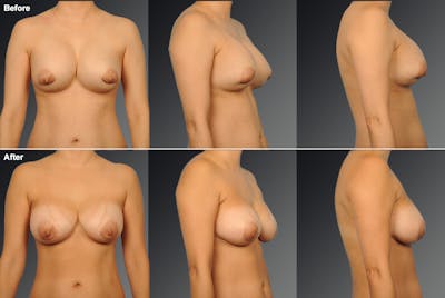 Breast Implant Revision Before & After Gallery - Patient 276773 - Image 1