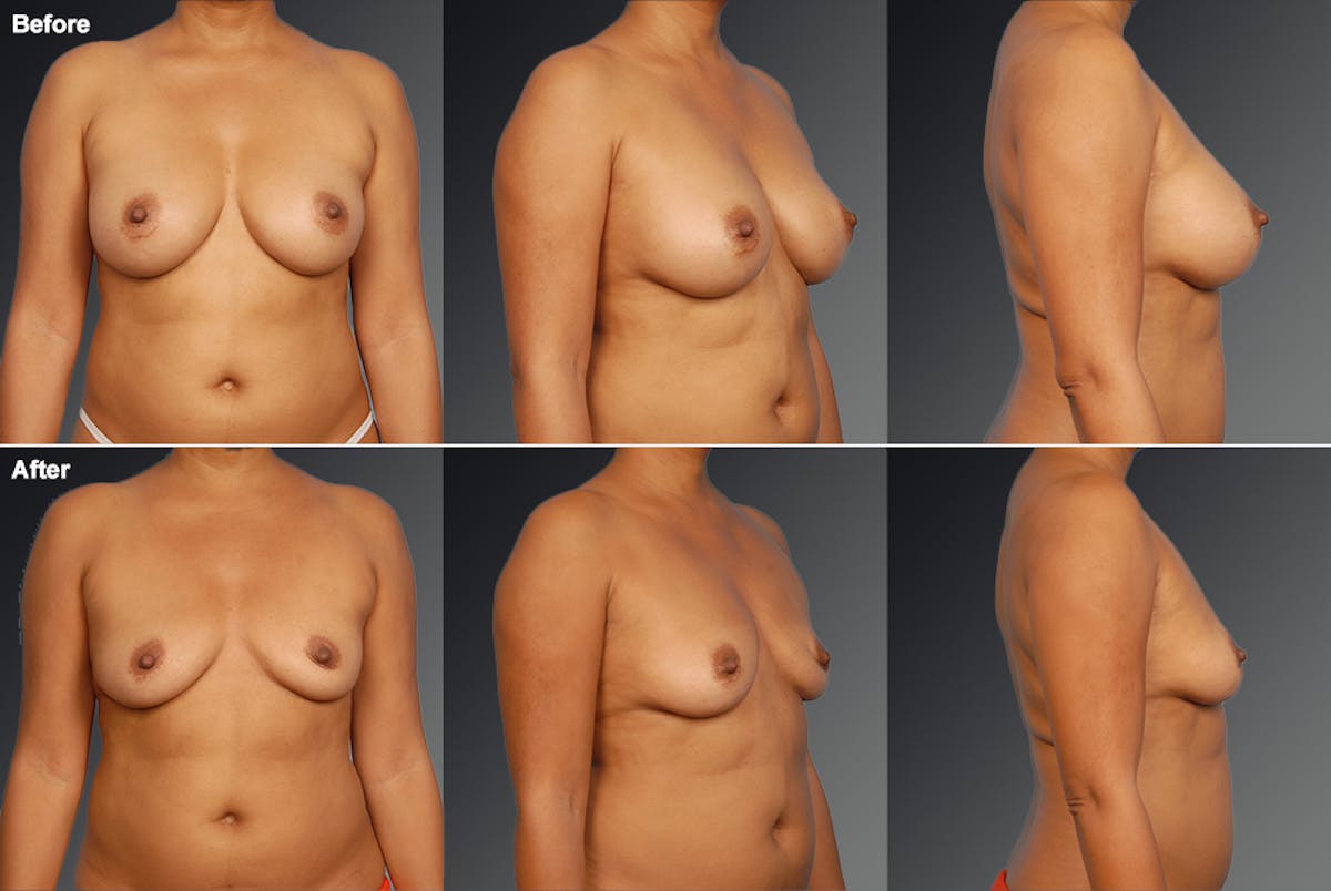 Explantation Before & After Gallery - Patient 190259 - Image 1