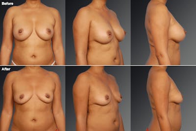Explantation Before & After Gallery - Patient 190259 - Image 1
