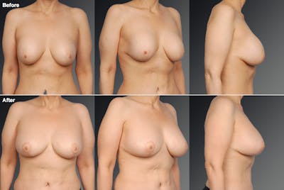 Capsular Contracture Before & After Gallery - Patient 174712 - Image 1