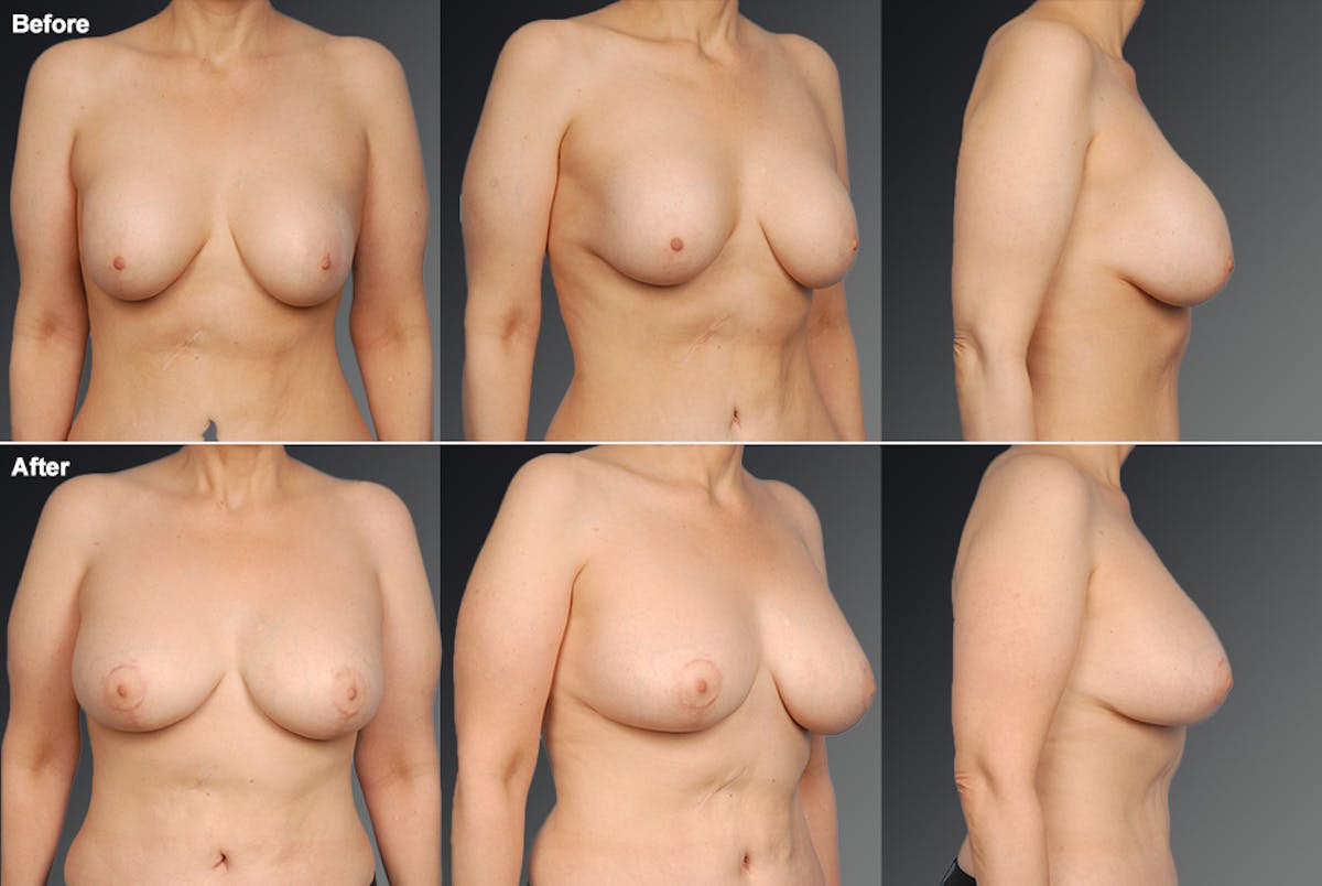 Capsular Contracture Before & After Gallery - Patient 174712 - Image 1
