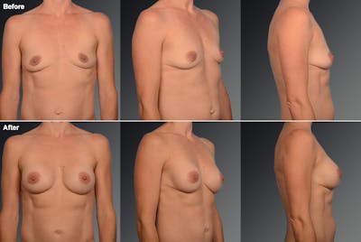 Breast Augmentation Before & After Gallery - Patient 405628 - Image 1