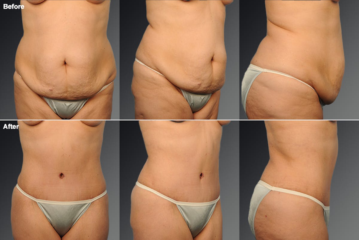 Tummy Tuck Before & After Gallery - Patient 388868 - Image 1