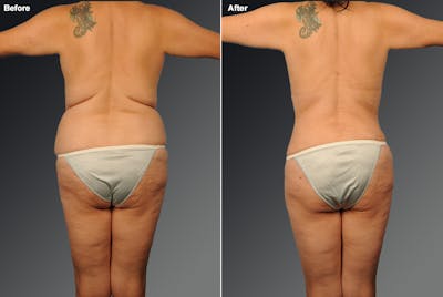 Liposuction Before & After Gallery - Patient 333718 - Image 1
